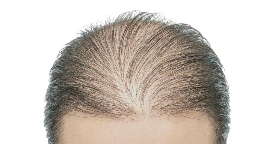 모발이식 불가 대상자