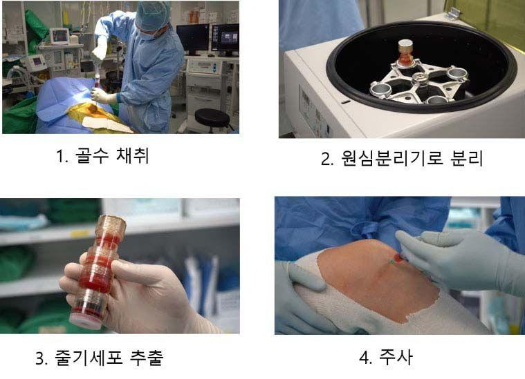 서울예스병원, 자가골수줄기세포주사치료 시행