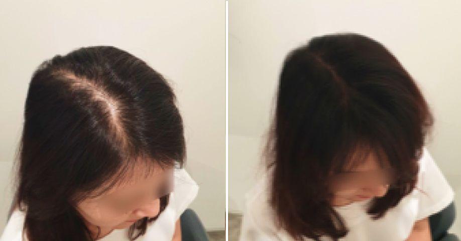 Hairline & Crown Hair Loss