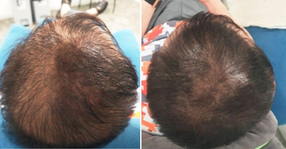 Early Hair Loss & Thinning Hair