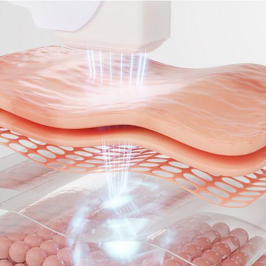High-Frequency Treatment
